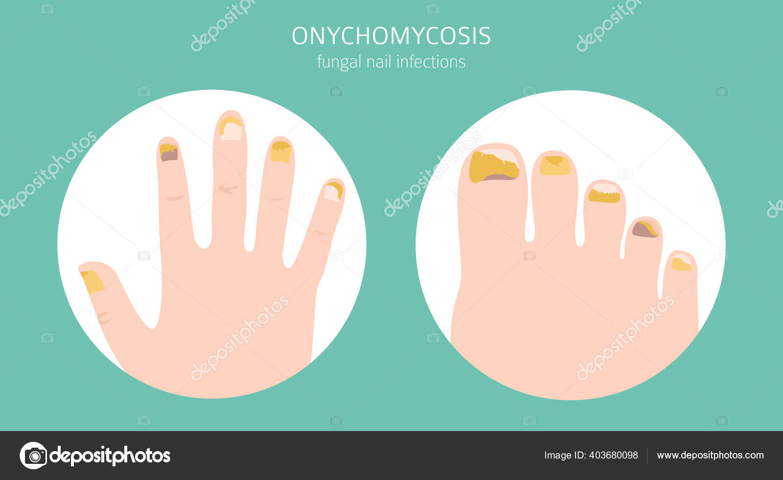 Get Rid of Toenail Fungus | Best Medical Remedies and Cures