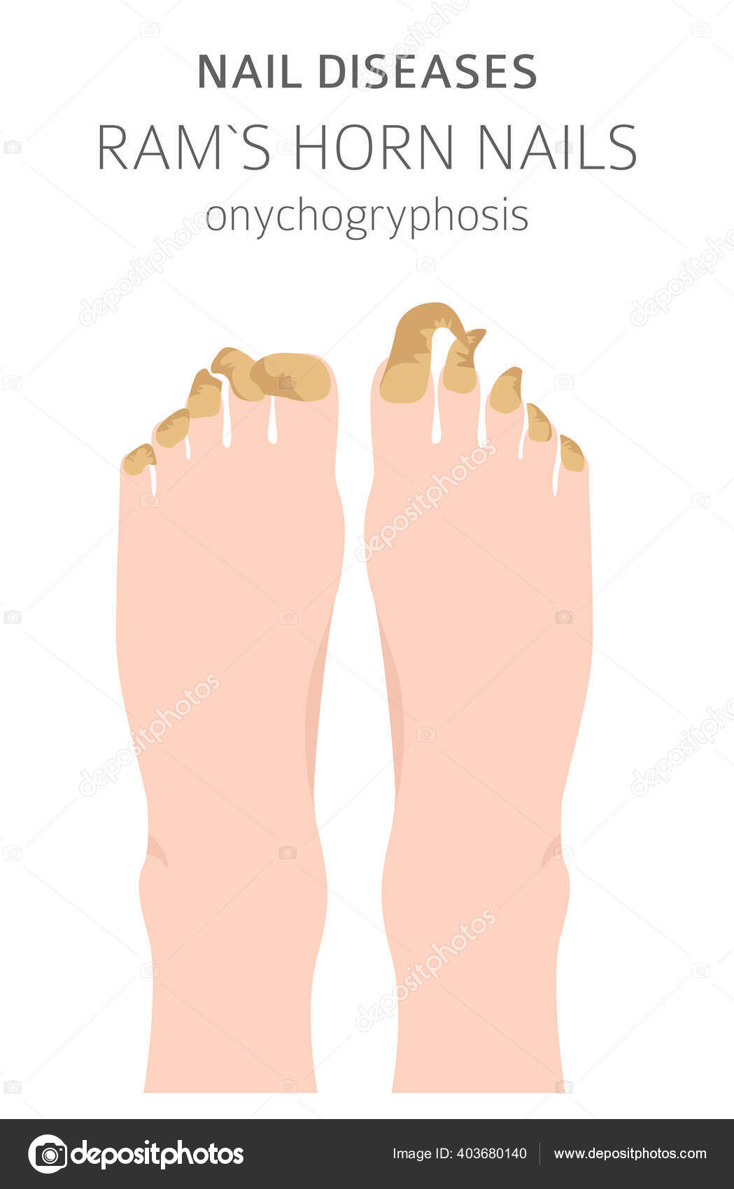 Nail Diseases Onychogryphosis Ram Horn Nail Medical Infographic Design Vector Stock Vector Image