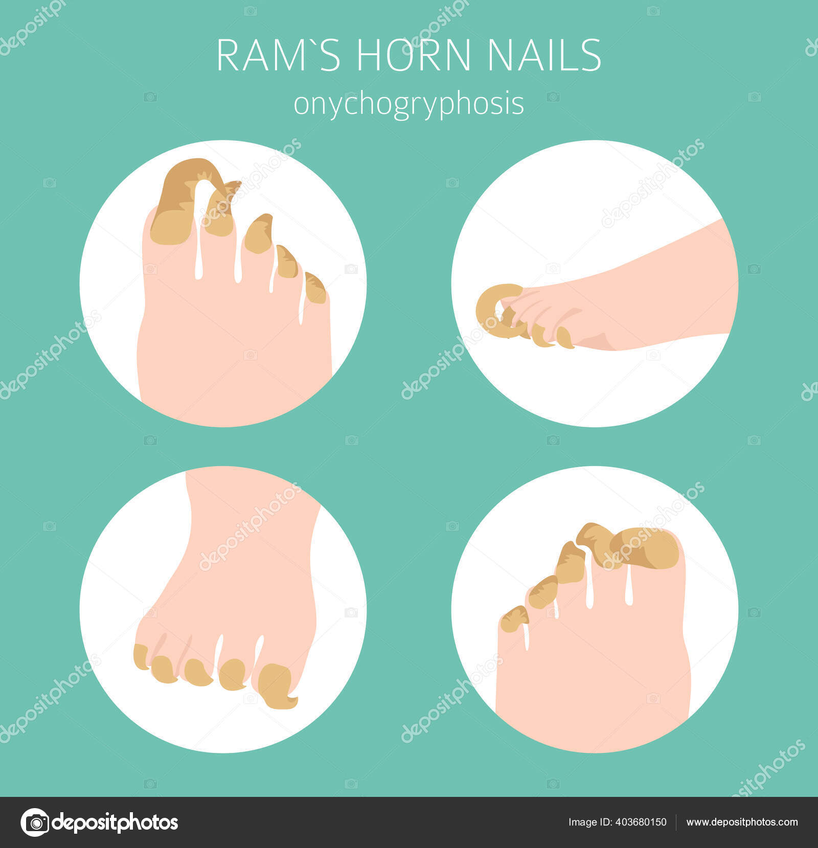 Onychogryphosis (Ram's Horn Nails): Causes & Treatment