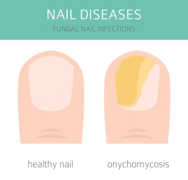 Nail diseases. Onychomycosis, nail fungal infection causes, treatment icon set. Medical infographic design.  Vector illustration clipart