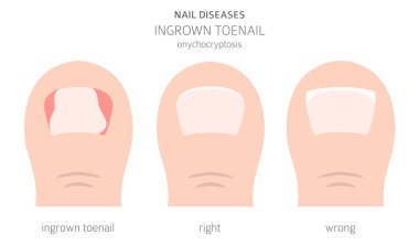 Nail diseases. Onychocryptocosis, ingrown toenail. Medical infographic design.  Vector illustration clipart