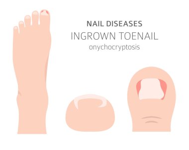 Nail diseases. Onychocryptocosis, ingrown toenail. Medical infographic design.  Vector illustration clipart