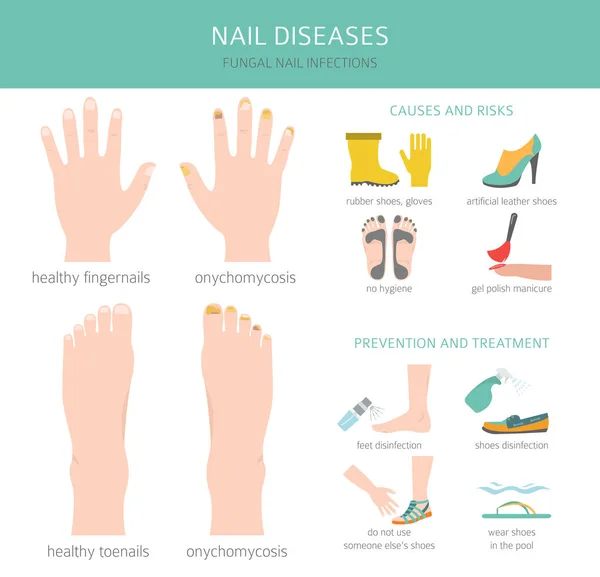 爪の病気だ 陰唇真菌症 爪真菌感染症の原因 治療アイコンを設定します 医療用インフォグラフィックデザイン ベクターイラスト — ストックベクタ