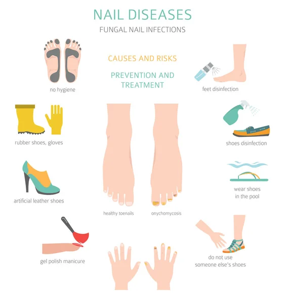 Nail Diseases Onychomycosis Nail Fungal Infection Causes Treatment Icon Set — Stock Vector