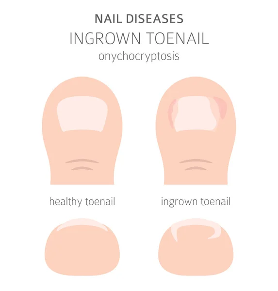 Tırnak Hastalıkları Onychoptocosis Içe Doğru Büyümüş Ayak Tırnağı Tıbbi Bilgi — Stok Vektör