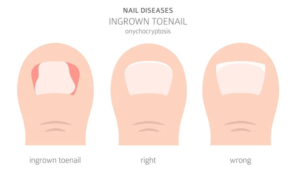 Doenças Das Unhas Onicriptocose Unha Encravada Projeto Infográfico Médico Ilustração — Vetor de Stock