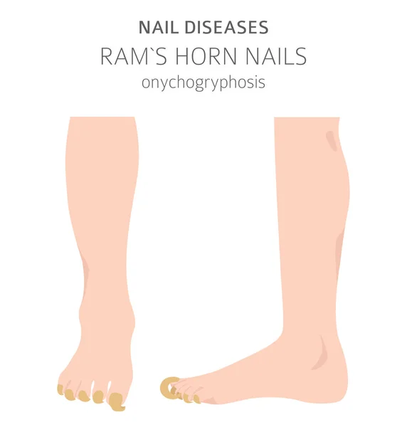 Nagelkrankheiten Onychogryphosis Widderhornnagel Gestaltung Medizinischer Infografik Vektorillustration — Stockvektor