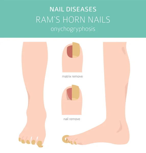 Nagelkrankheiten Onychogryphosis Widderhornnagel Gestaltung Medizinischer Infografik Vektorillustration — Stockvektor