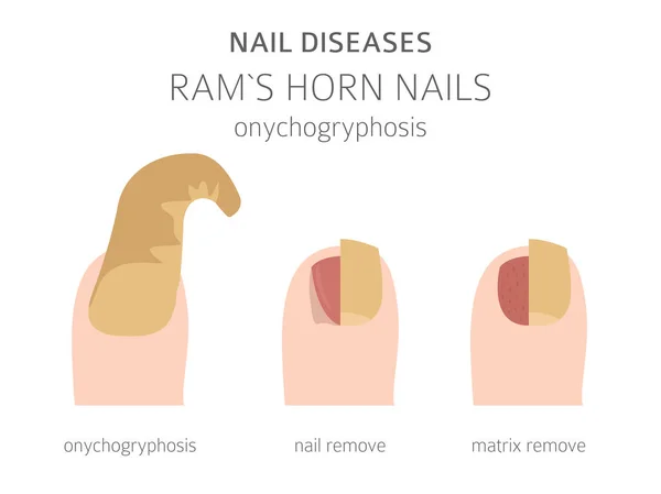 Enfermedades Las Uñas Oncogrifosis Uña Cuerno Carnero Diseño Infografía Médica — Vector de stock