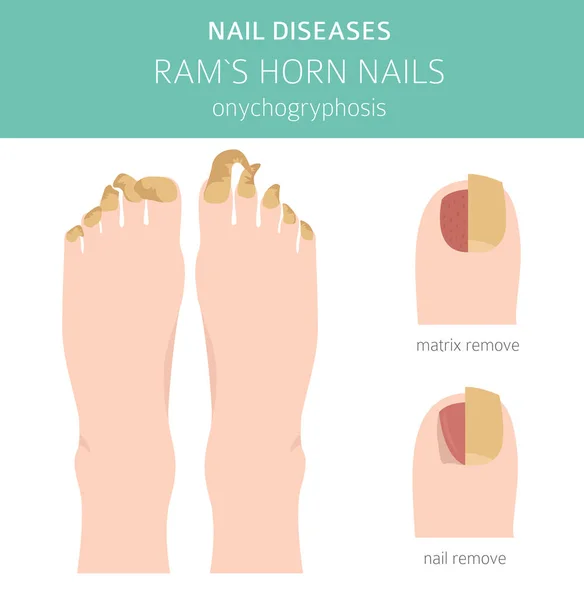 Nagelkrankheiten Onychogryphosis Widderhornnagel Gestaltung Medizinischer Infografik Vektorillustration — Stockvektor