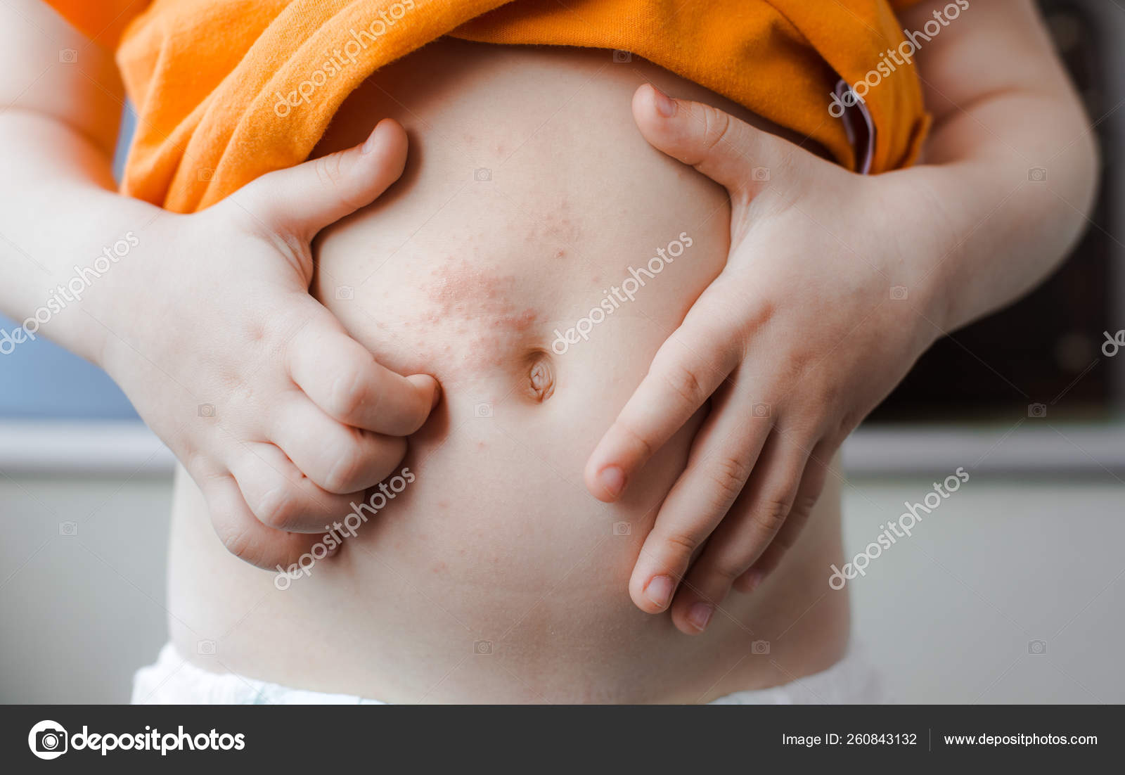 Chicken Pox Baby The Varicella Zoster Virus Or Scabies Rash On