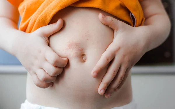 Chicken pox baby. The varicella zoster virus or scabies rash on the child. — Stock Photo, Image