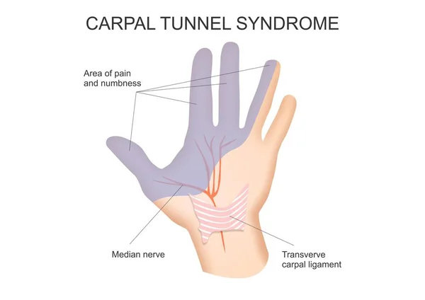 Carpal tunnel Vector Images | Depositphotos carpal-tunnel-vector-images-depositphotos