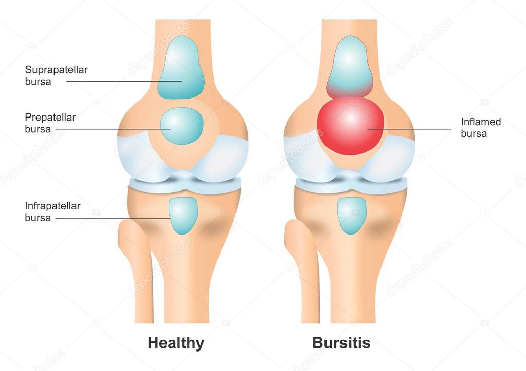Healthy Knee vs Bursitis Illustration