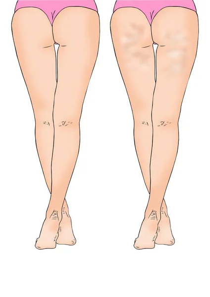 Fille Avec Jambes Cellulite — Image vectorielle