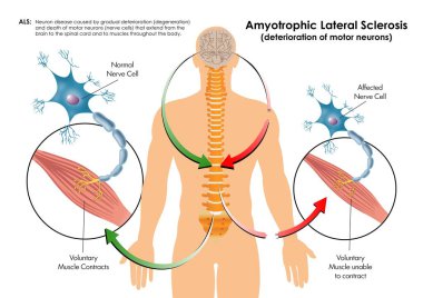 Amyotrophic Lateral Sclerosis Diagram clipart