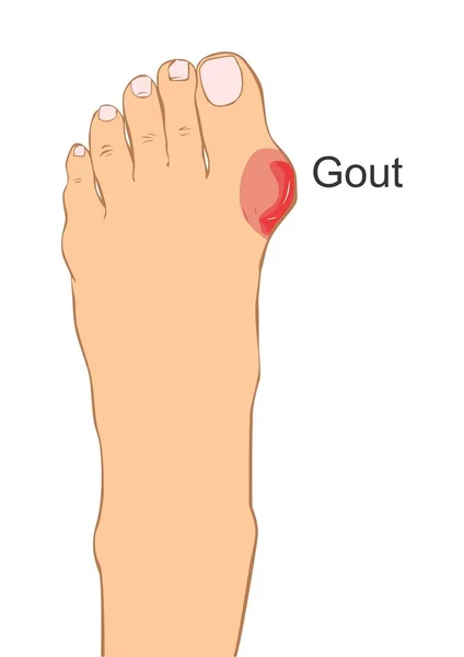 Painful Inflammed Gout — Stock Vector