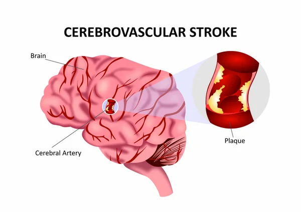Ictus Cerebrovascolare Incidente — Vettoriale Stock