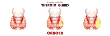 Gerçekçi tiroid bezinde düşük poli. İltihap kanser insan 3d tiroid bezi, gırtlak, berzah, nefes borusu. Vektör çizim.