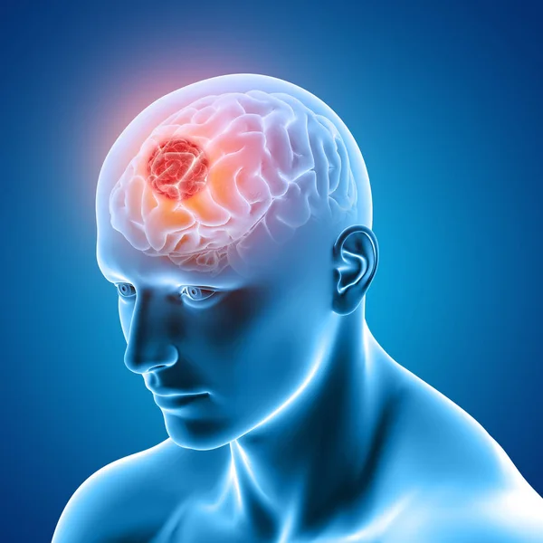 Obraz medyczny 3D przedstawiający postać męską z guzem mózgu — Zdjęcie stockowe