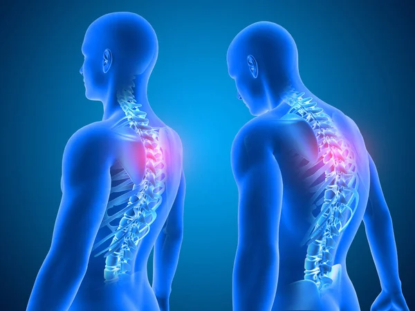 Render Medical Background Showing Good Poor Posture Spine Highlighted — Stock Photo, Image