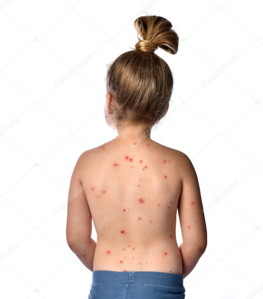 Chickenpox disease pimples on baby girl back and shoulders. Chicken pox virus outbreak in children. Concept of contagion 