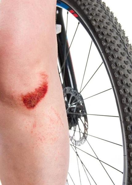 Frau Mit Gebrochenem Knie Auf Dem Fahrrad Nahaufnahme — Stockfoto