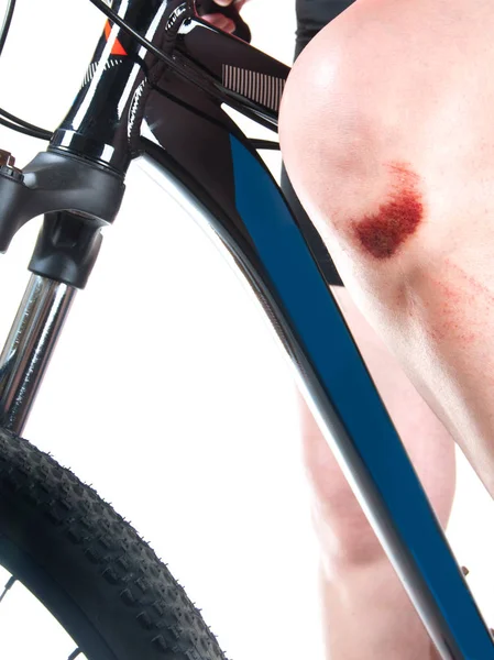 Frau Mit Gebrochenem Knie Auf Dem Fahrrad Nahaufnahme — Stockfoto