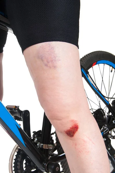 Frau Mit Gebrochenem Knie Auf Dem Fahrrad Nahaufnahme — Stockfoto