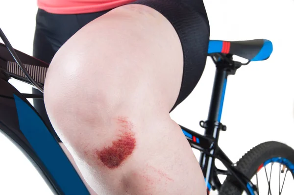 Frau Mit Gebrochenem Knie Auf Dem Fahrrad Nahaufnahme — Stockfoto