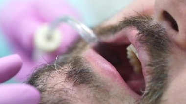 Sakallı ve bıyıklı beyaz bir erkekle tartar temizliyorum. 