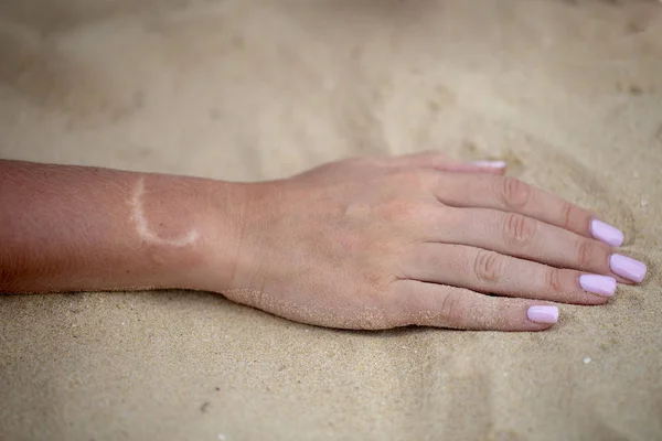 Hand Scar — Stock Photo, Image