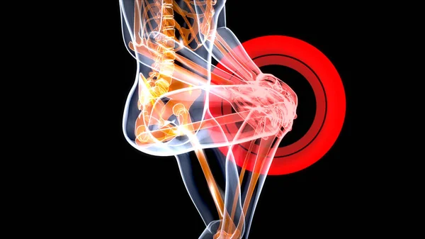 膝の捻挫や痛みにつながる3Dイラスト — ストック写真