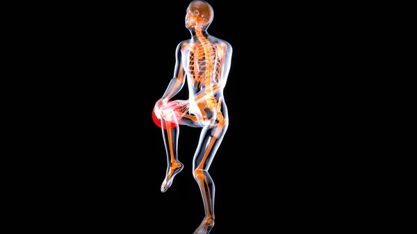 膝关节扭伤或疼痛导致疼痛3D图解 — 图库照片