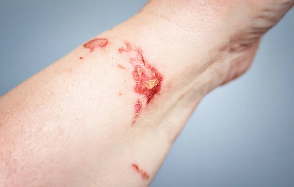 Chemical burn on the skin — Stock Photo, Image