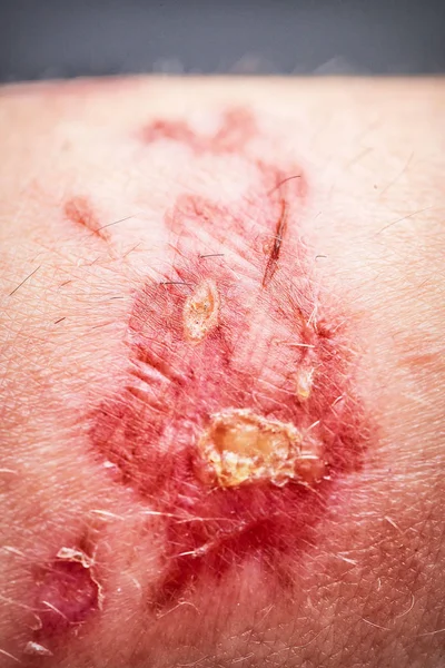 Chemical burn on the skin — Stock Photo, Image