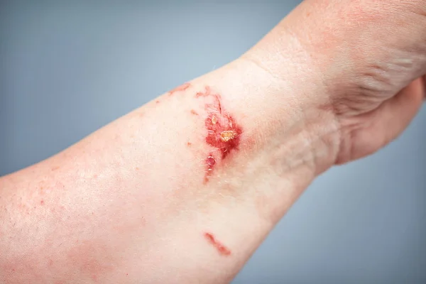 Chemical burn on the skin — Stock Photo, Image