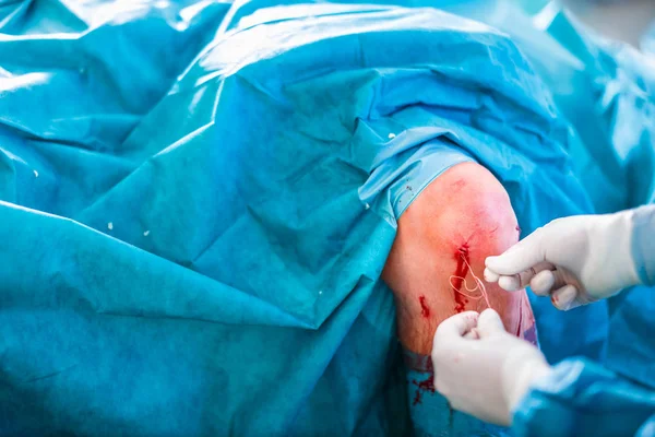 Хирургия Колена Ортопедическая Операция Два Хирурга Выполняющие Операцию Колене Пациента — стоковое фото