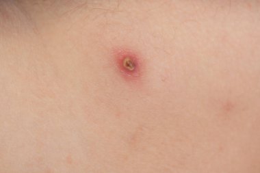 Cildinde büyük kırmızı kaynar sivilce kürkü, iltihaplı çıban, dermatoloji fotoğrafı.