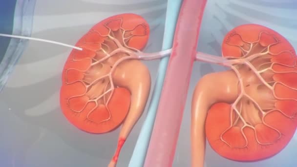 Ureteral Stent Procedure Animation — Stock Video © volkan83 #228684328 Ureteral Stent Procedure Animation — Stock Video © volkan83 #228684328