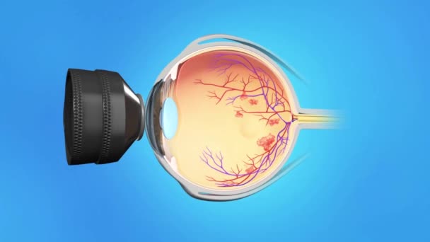 Medical animation of eye laser treatment on blue background — Stock Video © volkan83 #265623622 Medical animation of eye laser treatment on blue background — Stock Video © volkan83 #265623622