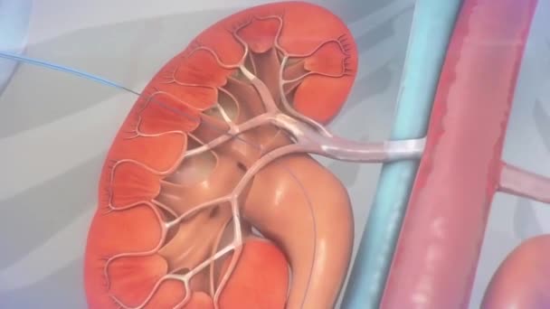 Ureteral Stent Procedure Animation — Stock Video © volkan83 #228684328
