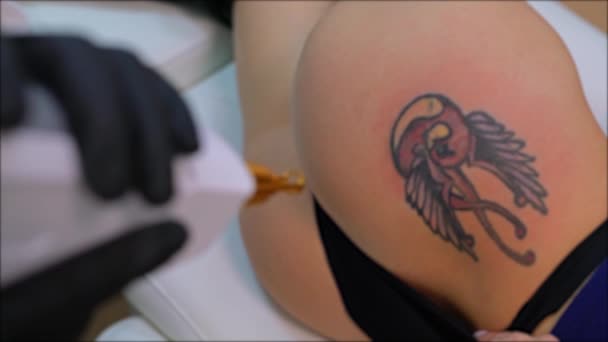Processo de remoção de vídeo de tatuagem a laser — Vídeo de Stock