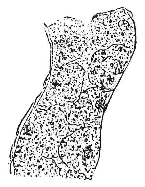 Gonflement trouble de l'épithélium tapissant un tubule rénal, millésime — Image vectorielle