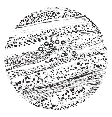 Yağ dejenerasyonu kalp, vintage oyma.