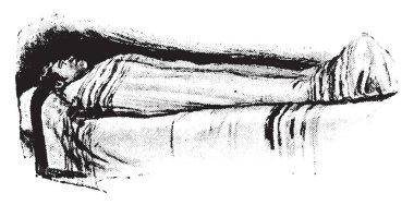 Paket paketi, hasta kısmen sarılmış, vintage oyma.