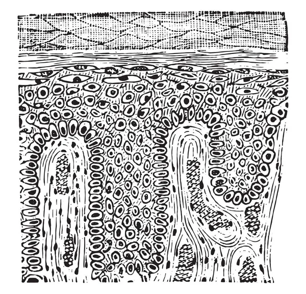 Epithelioma Πλακώδη Vintage Χαραγμένο Εικονογράφηση — Διανυσματικό Αρχείο