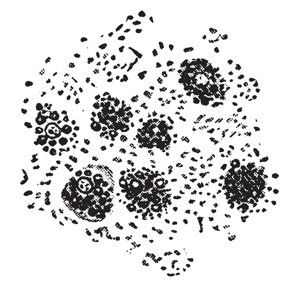 Degeneración Grasa Las Células Hepáticas Ilustración Grabada Vintage — Archivo Imágenes Vectoriales