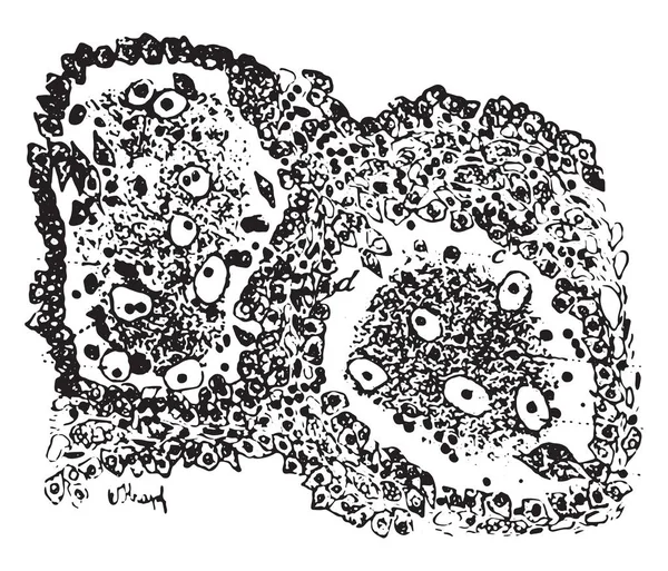 Pneumonie tuberculeuse, gravure vintage . — Image vectorielle