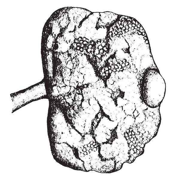 신장 보여주는 고급 만성 간 질 성 신장 염, 빈티지 — 스톡 벡터